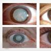 Лечение помутнения хрусталика глаза