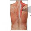 Cum se manifestă miozita mușchilor lombari?
