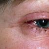 Poludan - udhëzime për përdorimin e pikave të syve në sy Poludan udhëzime për përdorim për fëmijë