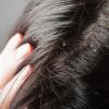 비듬의 원인과 종류 여성의 머리에 비듬이 생기는 이유