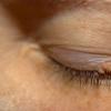 Chalazion บนเปลือกตาบน: วิธีการรักษาโรค สีแดงและความหนาของเปลือกตาบน