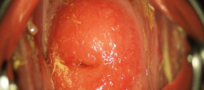 ¿Qué es la cervicitis crónica del cuello uterino?