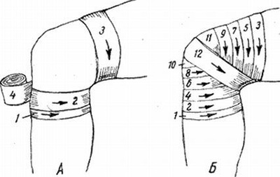 Как бинтовать колено. Черепашья повязка на коленный сустав. Сходящаяся черепашья повязка на коленный сустав алгоритм. Наложение сходящейся повязки на коленный сустав. Наложение повязки на коленный сустав алгоритм.